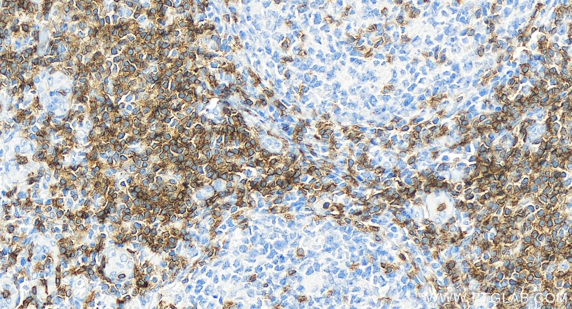 Immunohistochemistry (IHC) staining of human tonsillitis tissue using CD3 Gamma Recombinant antibody (84836-2-RR)