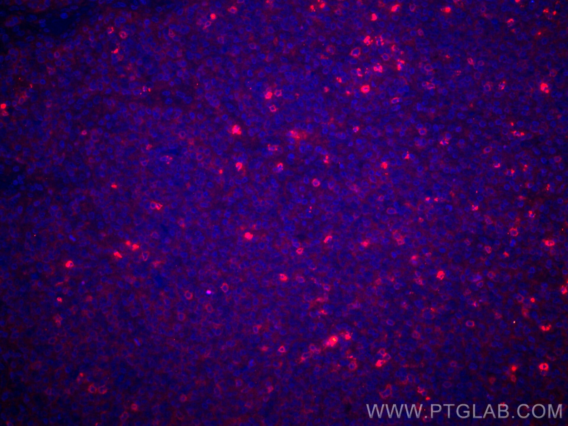 Immunofluorescence (IF) / fluorescent staining of human tonsillitis tissue using CoraLite®594-conjugated CD3 gamma Monoclonal antib (CL594-60347)