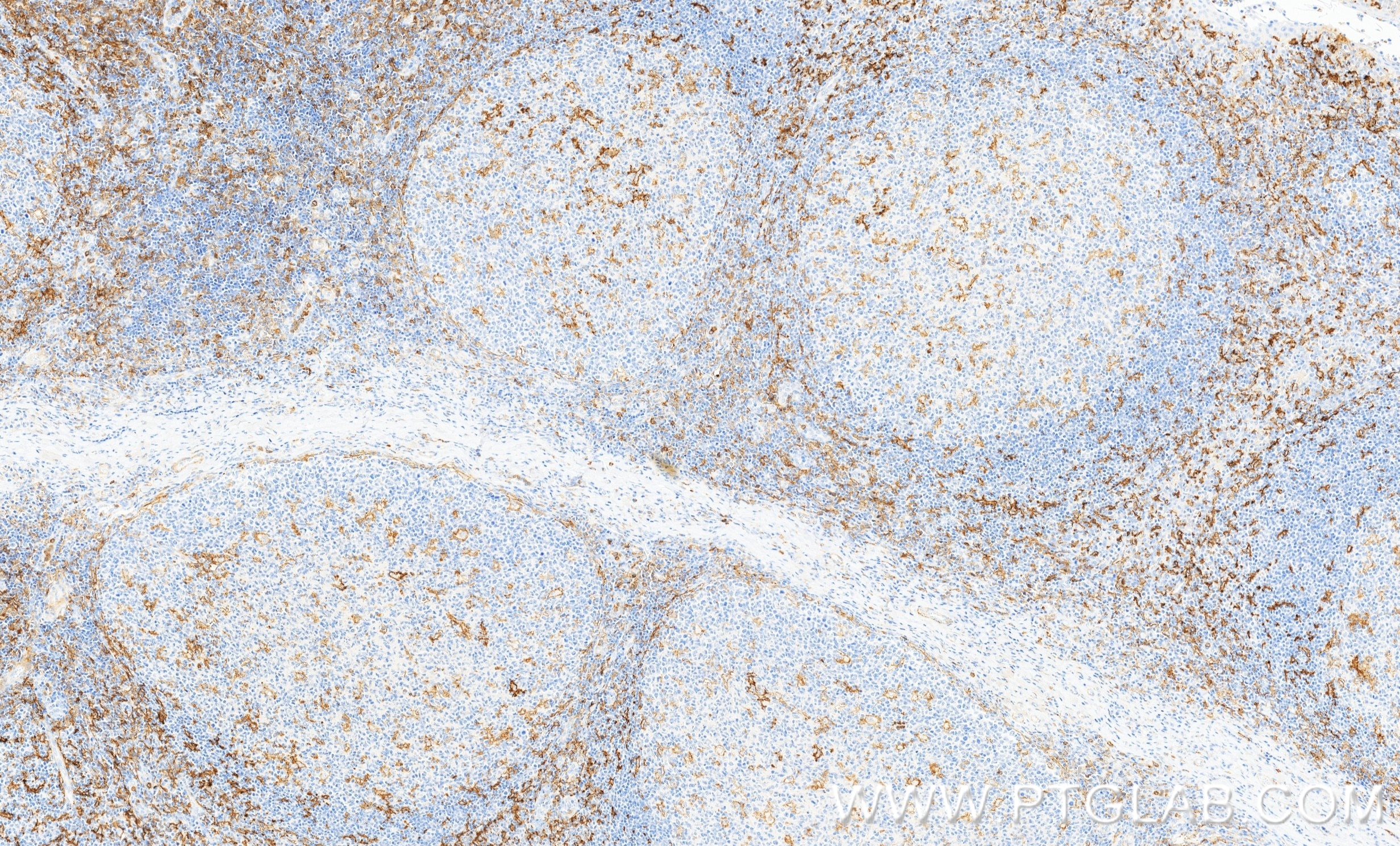 IHC staining of human tonsillitis using 87497-1-RR Immunohistochemistry (IHC) staining of human tonsillitis tissue using CD300f Recombinant monoclonal antibody (87497-1-RR)