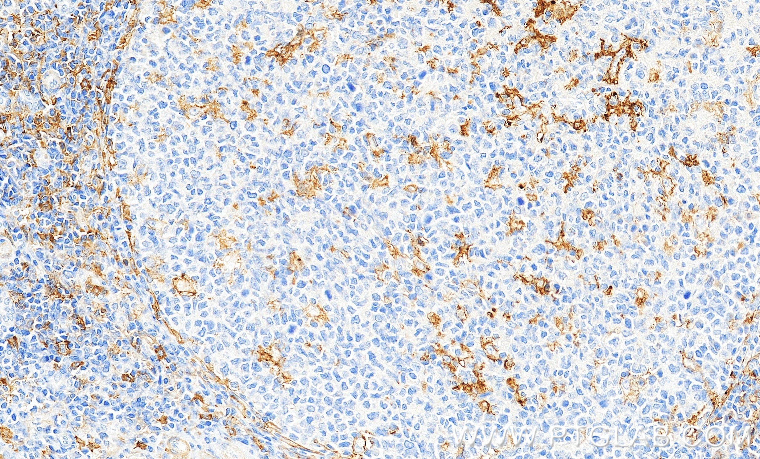 IHC staining of human tonsillitis using 87497-1-RR Immunohistochemistry (IHC) staining of human tonsillitis tissue using CD300f Recombinant monoclonal antibody (87497-1-RR)
