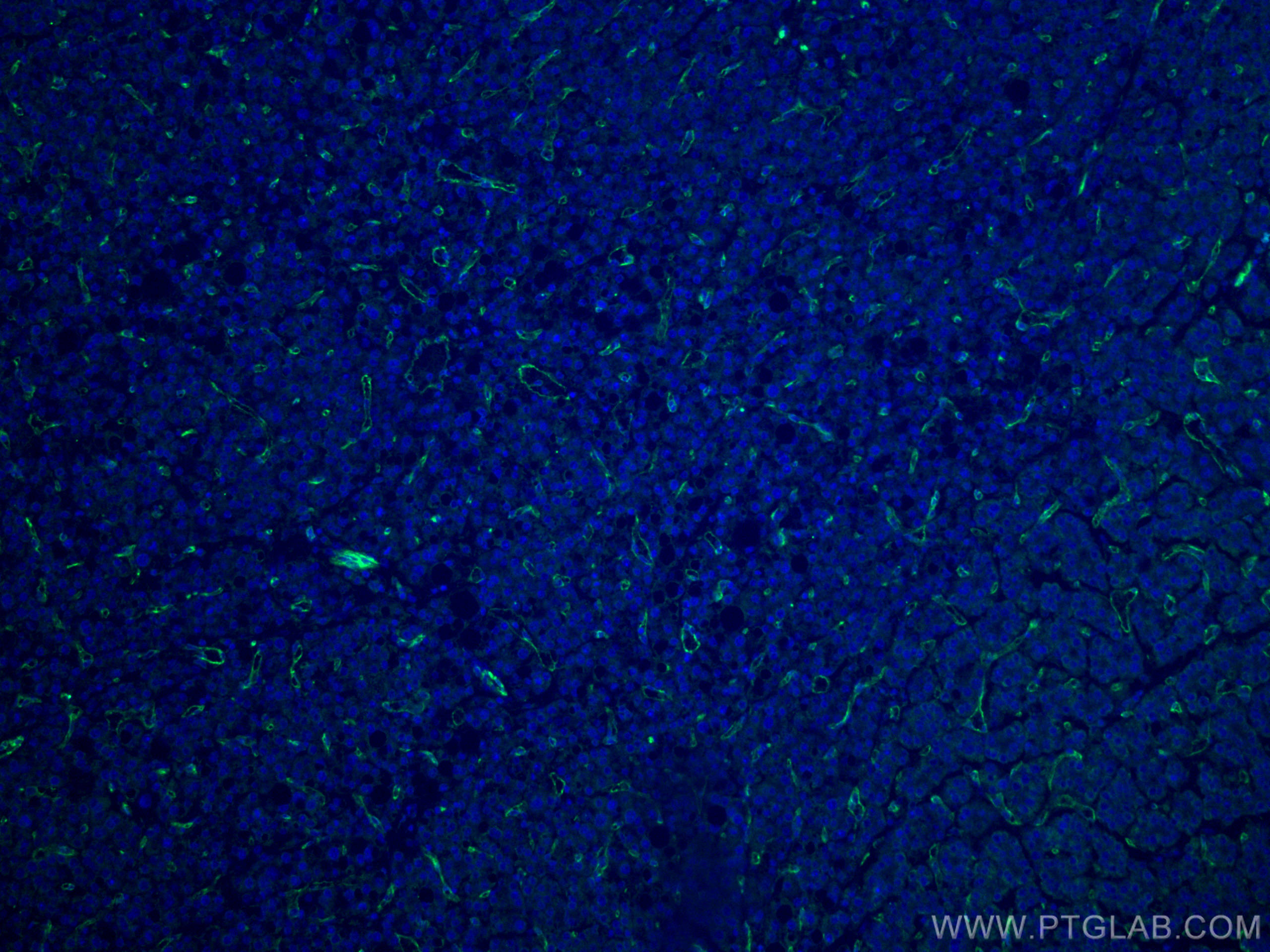 Immunofluorescence (IF) / fluorescent staining of human liver cancer tissue using CD31 Monoclonal antibody (66065-2-Ig)