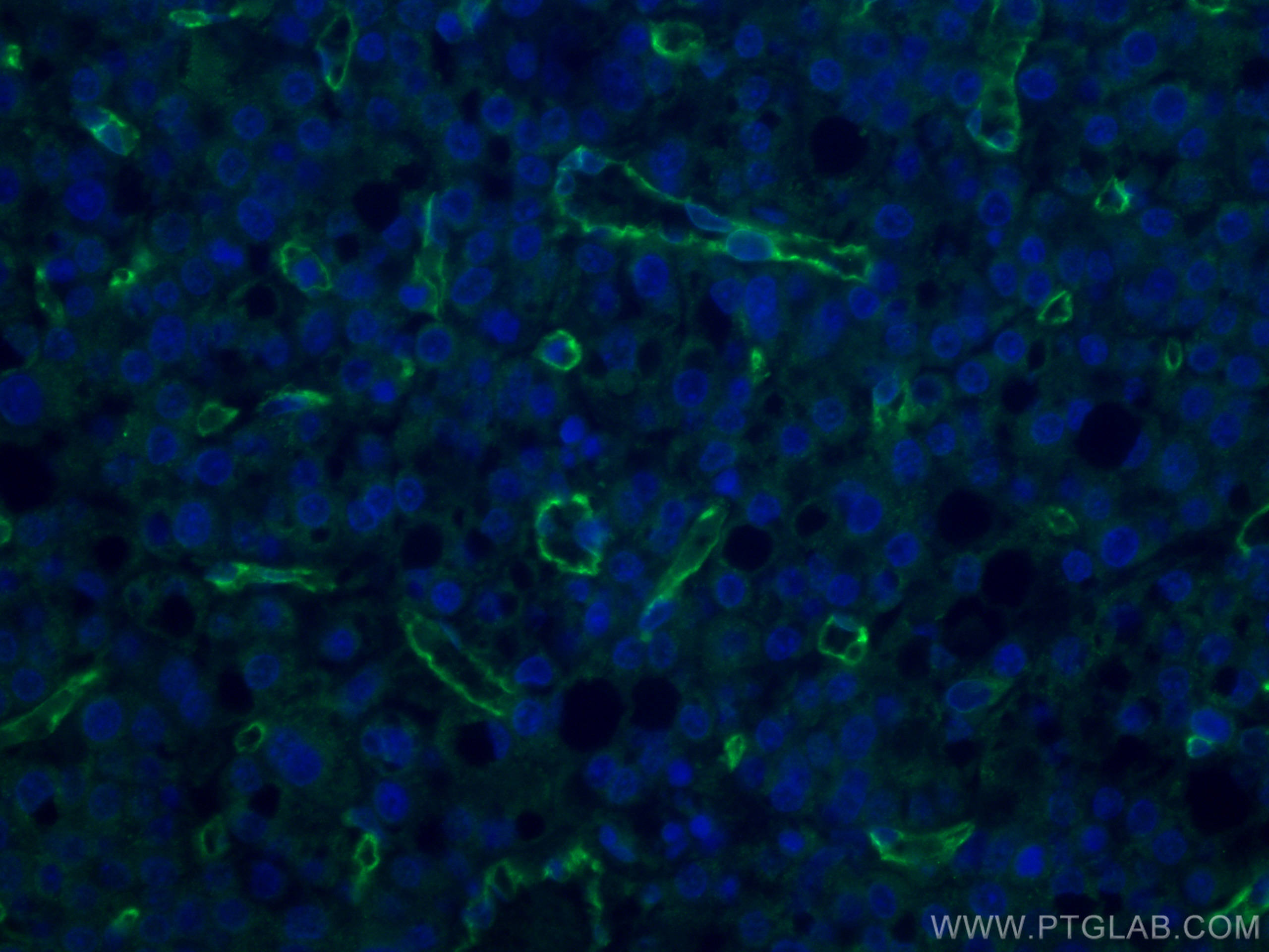 Immunofluorescence (IF) / fluorescent staining of human liver cancer tissue using CD31 Monoclonal antibody (66065-2-Ig)