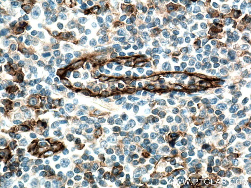 Immunohistochemistry (IHC) staining of human tonsillitis tissue using CD31 Monoclonal antibody (66065-2-Ig)