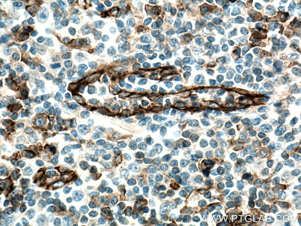 IHC staining of human tonsillitis using 66065-2-Ig