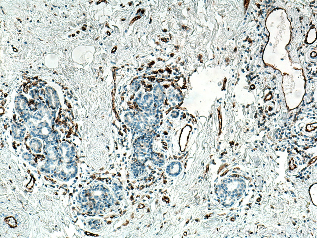 Immunohistochemistry (IHC) staining of human breast cancer tissue using CD31 Monoclonal antibody (66065-2-Ig)
