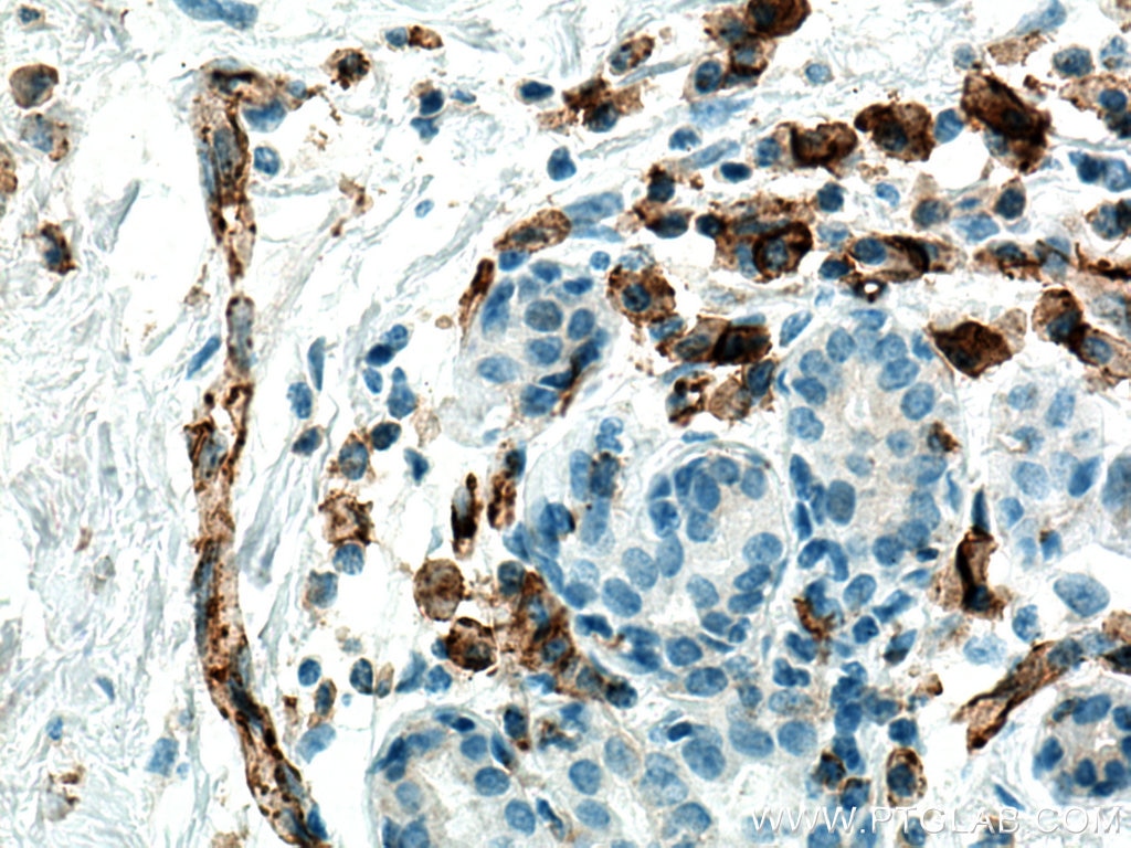 Immunohistochemistry (IHC) staining of human breast cancer tissue using CD31 Monoclonal antibody (66065-2-Ig)