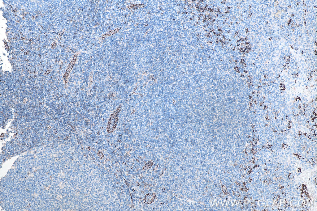 IHC staining of human tonsillitis using 66065-2-Ig Immunohistochemistry (IHC) staining of human tonsillitis tissue using CD31 Monoclonal antibody (66065-2-Ig)