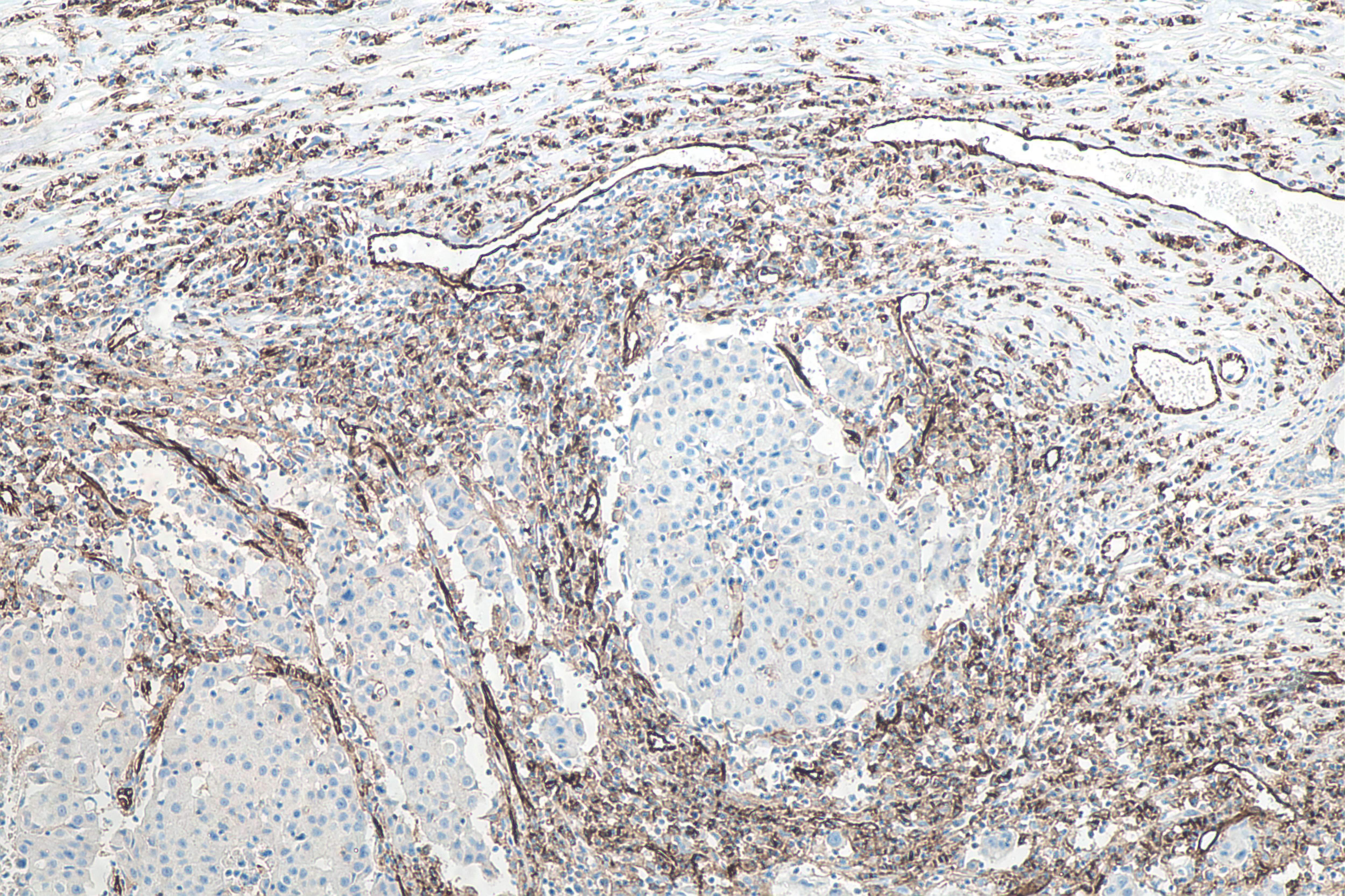 IHC staining of human breast cancer using 66065-2-Ig Immunohistochemistry (IHC) staining of human breast cancer tissue using CD31 Monoclonal antibody (66065-2-Ig)