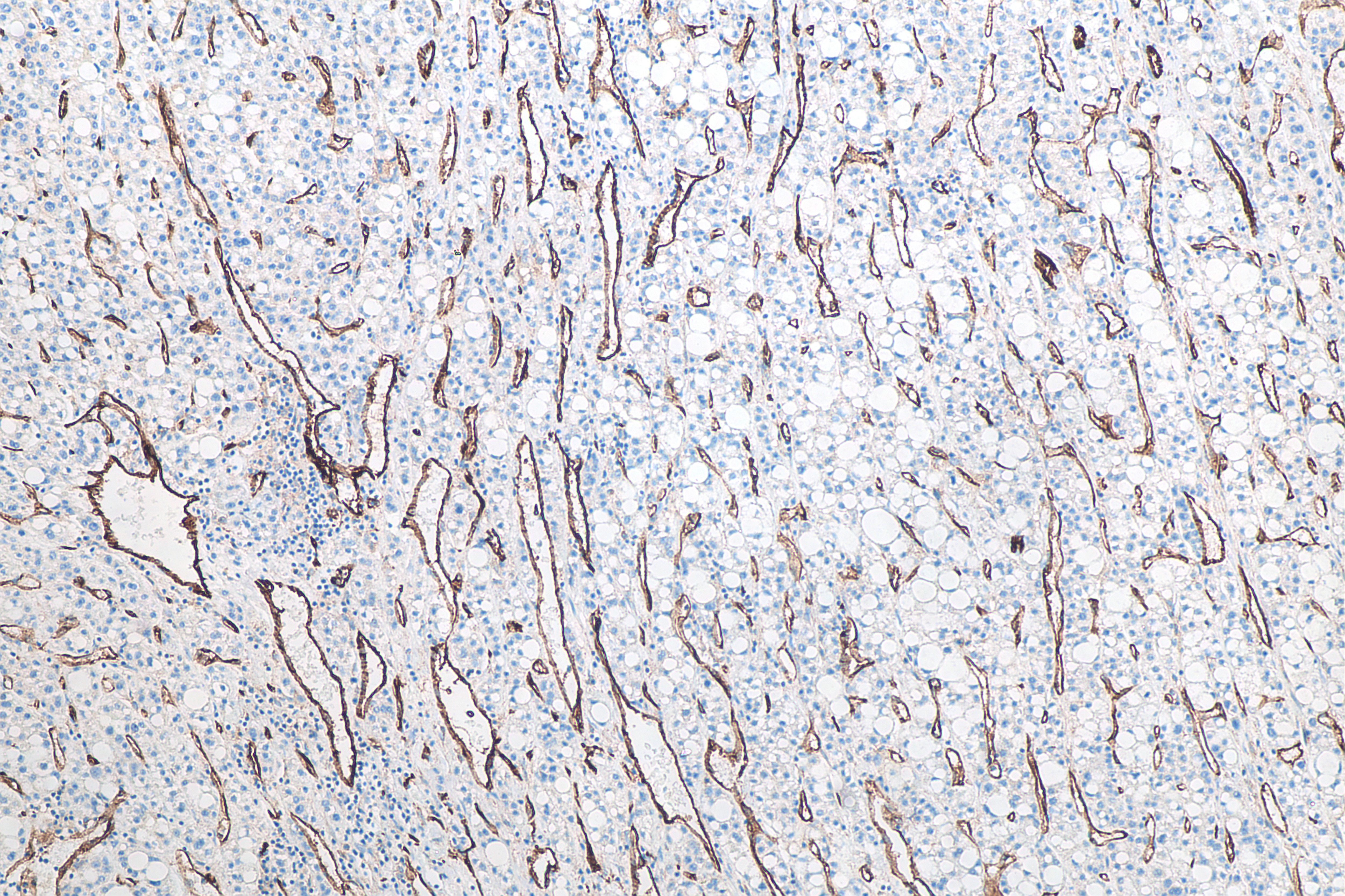 Immunohistochemistry (IHC) staining of human liver cancer tissue using CD31 Monoclonal antibody (66065-2-Ig)