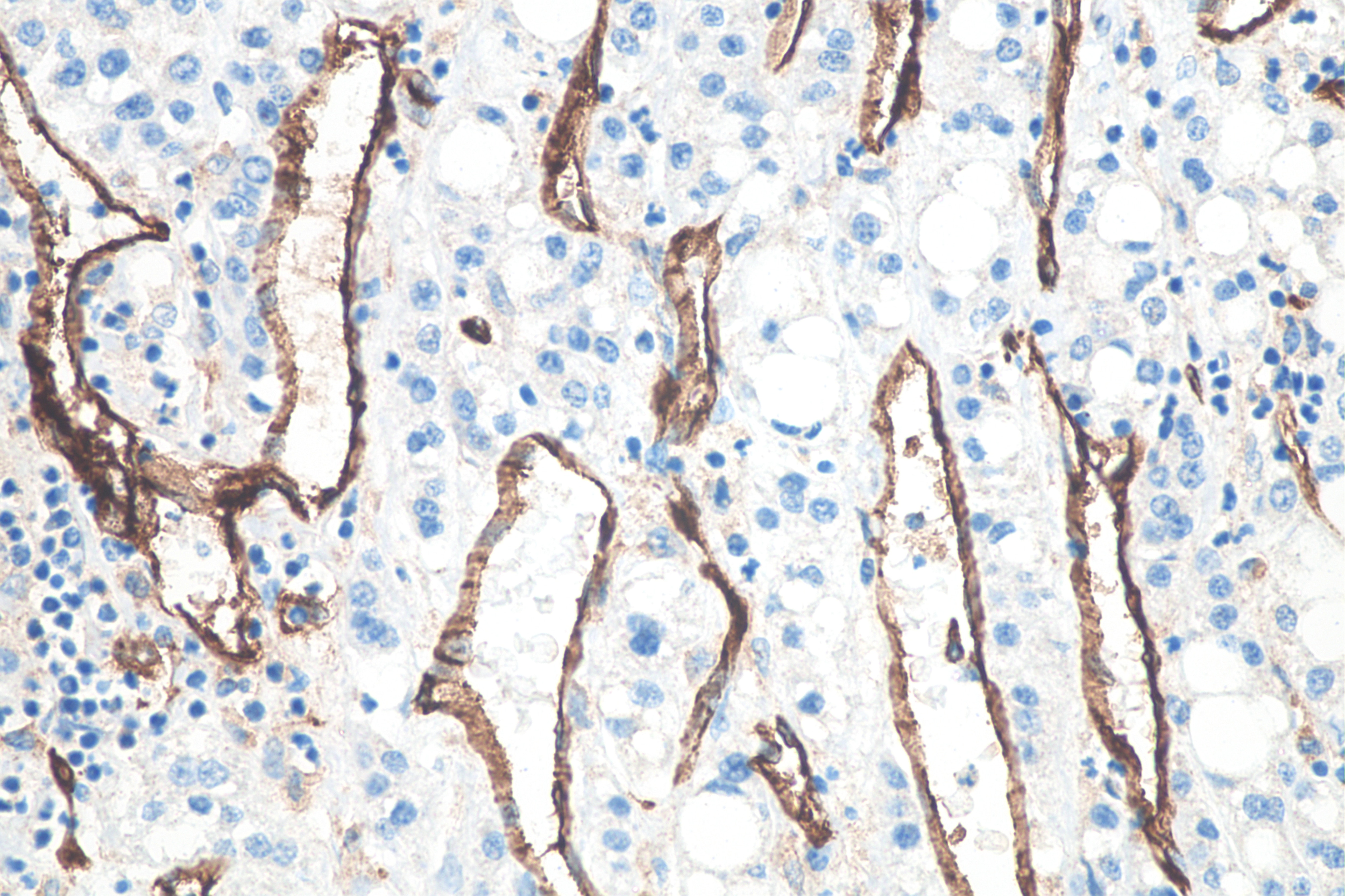 Immunohistochemistry (IHC) staining of human liver cancer tissue using CD31 Monoclonal antibody (66065-2-Ig)