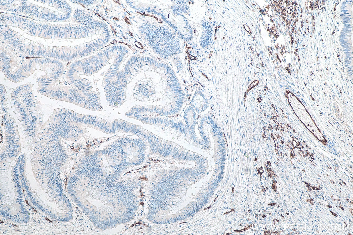 IHC staining of human colon cancer using 66065-2-Ig Immunohistochemistry (IHC) staining of human colon cancer tissue using CD31 Monoclonal antibody (66065-2-Ig)