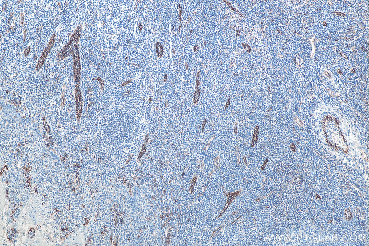 IHC staining of human tonsillitis using 66065-2-Ig Immunohistochemistry (IHC) staining of human tonsillitis tissue using CD31 Monoclonal antibody (66065-2-Ig)