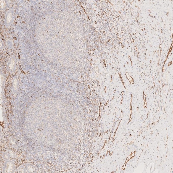Immunohistochemistry (IHC) staining of human appendicitis tissue using CD31 Monoclonal antibody (66065-2-Ig)