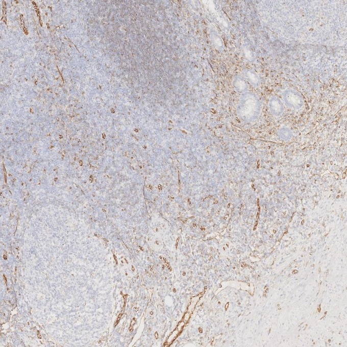 Immunohistochemistry (IHC) staining of human appendicitis tissue using CD31 Monoclonal antibody (66065-2-Ig)