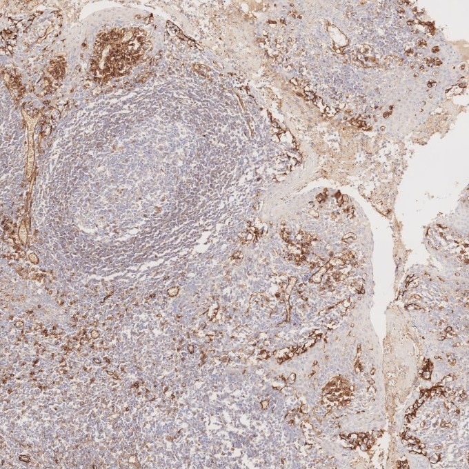 Immunohistochemistry (IHC) staining of human tonsillitis tissue using CD31 Monoclonal antibody (66065-2-Ig)
