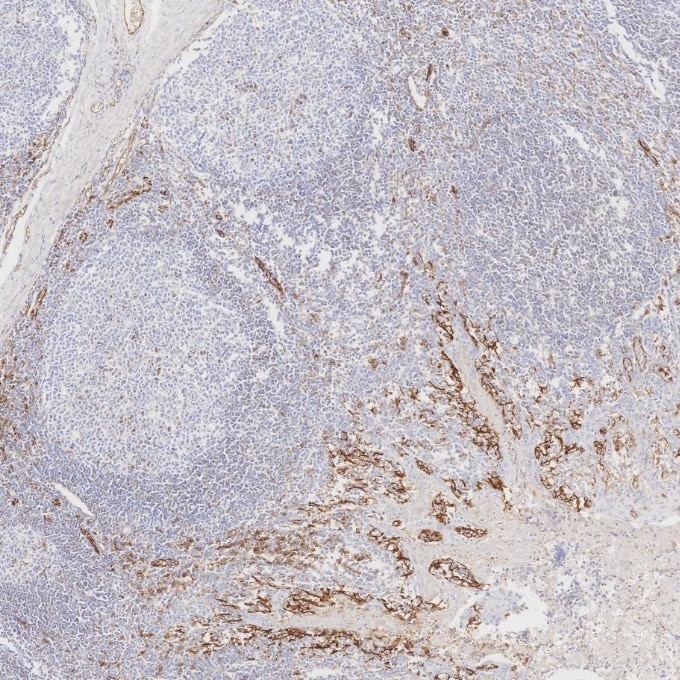 Immunohistochemistry (IHC) staining of human tonsillitis tissue using CD31 Monoclonal antibody (66065-2-Ig)