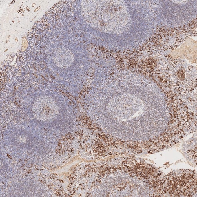 Immunohistochemistry (IHC) staining of human tonsillitis tissue using CD31 Monoclonal antibody (66065-2-Ig)