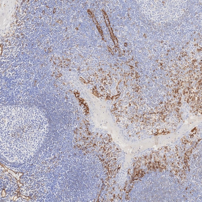 Immunohistochemistry (IHC) staining of human tonsillitis tissue using CD31 Monoclonal antibody (66065-2-Ig)
