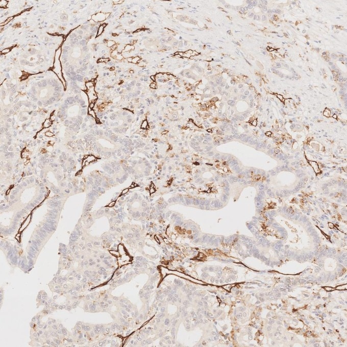 Immunohistochemistry (IHC) staining of human pancreas cancer tissue using CD31 Monoclonal antibody (66065-2-Ig)