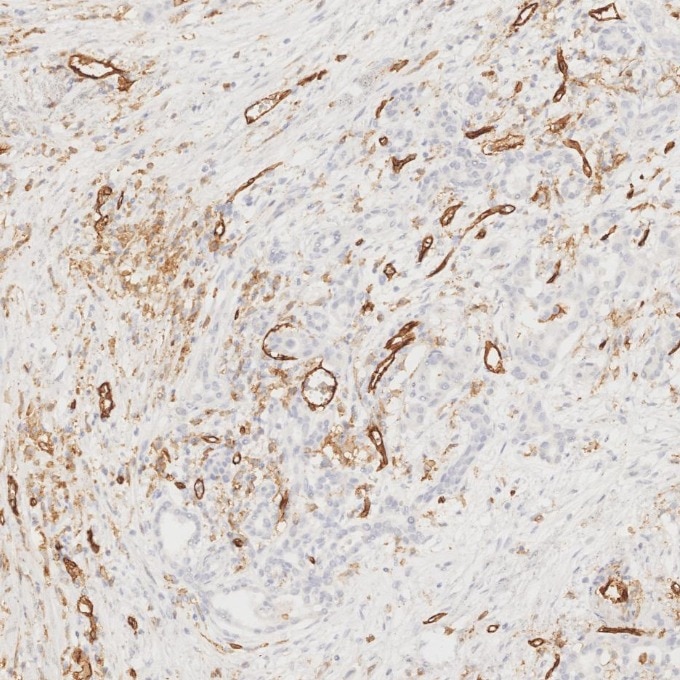 Immunohistochemistry (IHC) staining of human pancreas cancer tissue using CD31 Monoclonal antibody (66065-2-Ig)