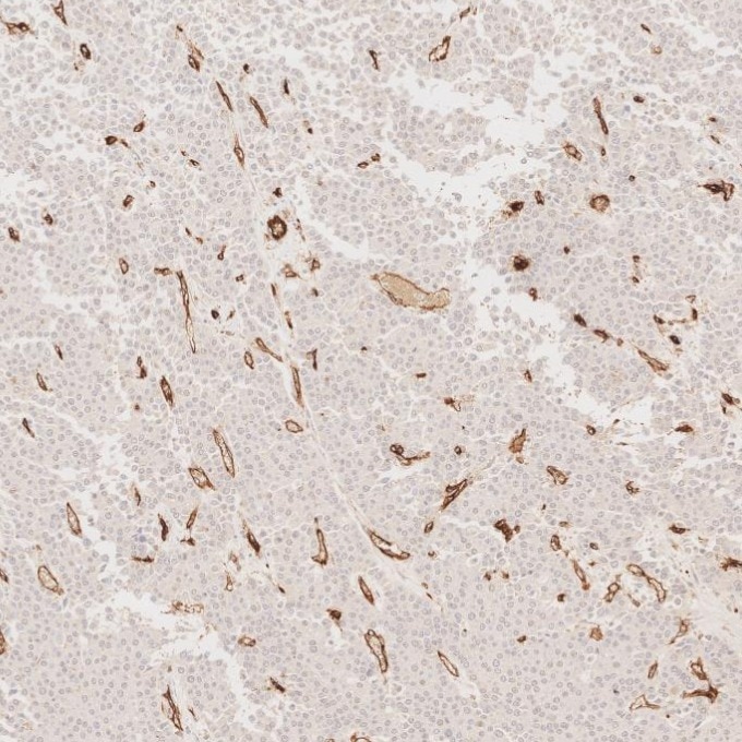 Immunohistochemistry (IHC) staining of human liver cancer tissue using CD31 Monoclonal antibody (66065-2-Ig)
