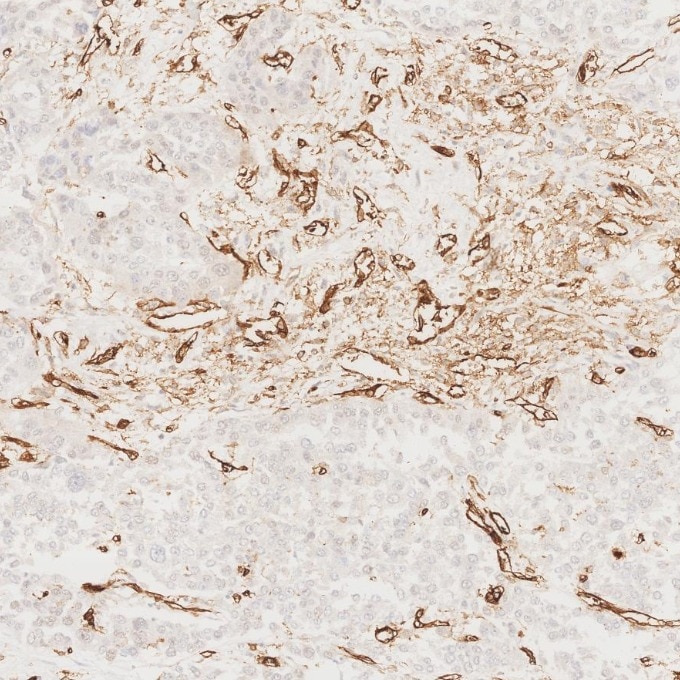 Immunohistochemistry (IHC) staining of human liver cancer tissue using CD31 Monoclonal antibody (66065-2-Ig)