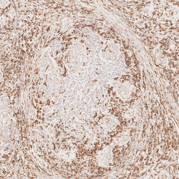 Immunohistochemistry (IHC) staining of human stomach cancer tissue using CD31 Monoclonal antibody (66065-2-Ig)