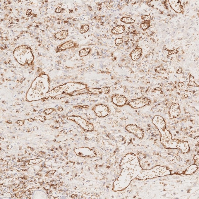 Immunohistochemistry (IHC) staining of human oesophagus cancer tissue using CD31 Monoclonal antibody (66065-2-Ig)