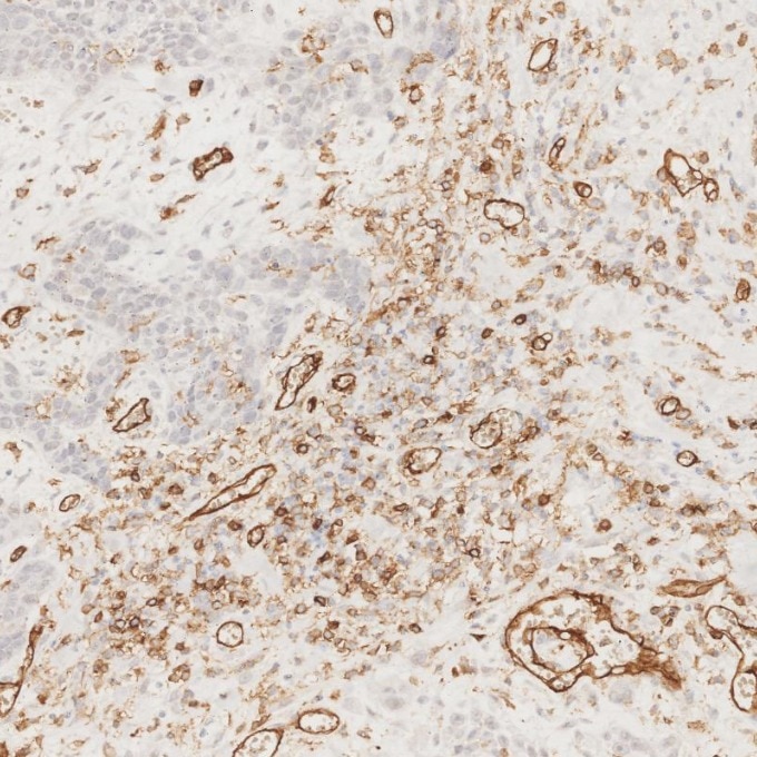 Immunohistochemistry (IHC) staining of human oesophagus cancer tissue using CD31 Monoclonal antibody (66065-2-Ig)