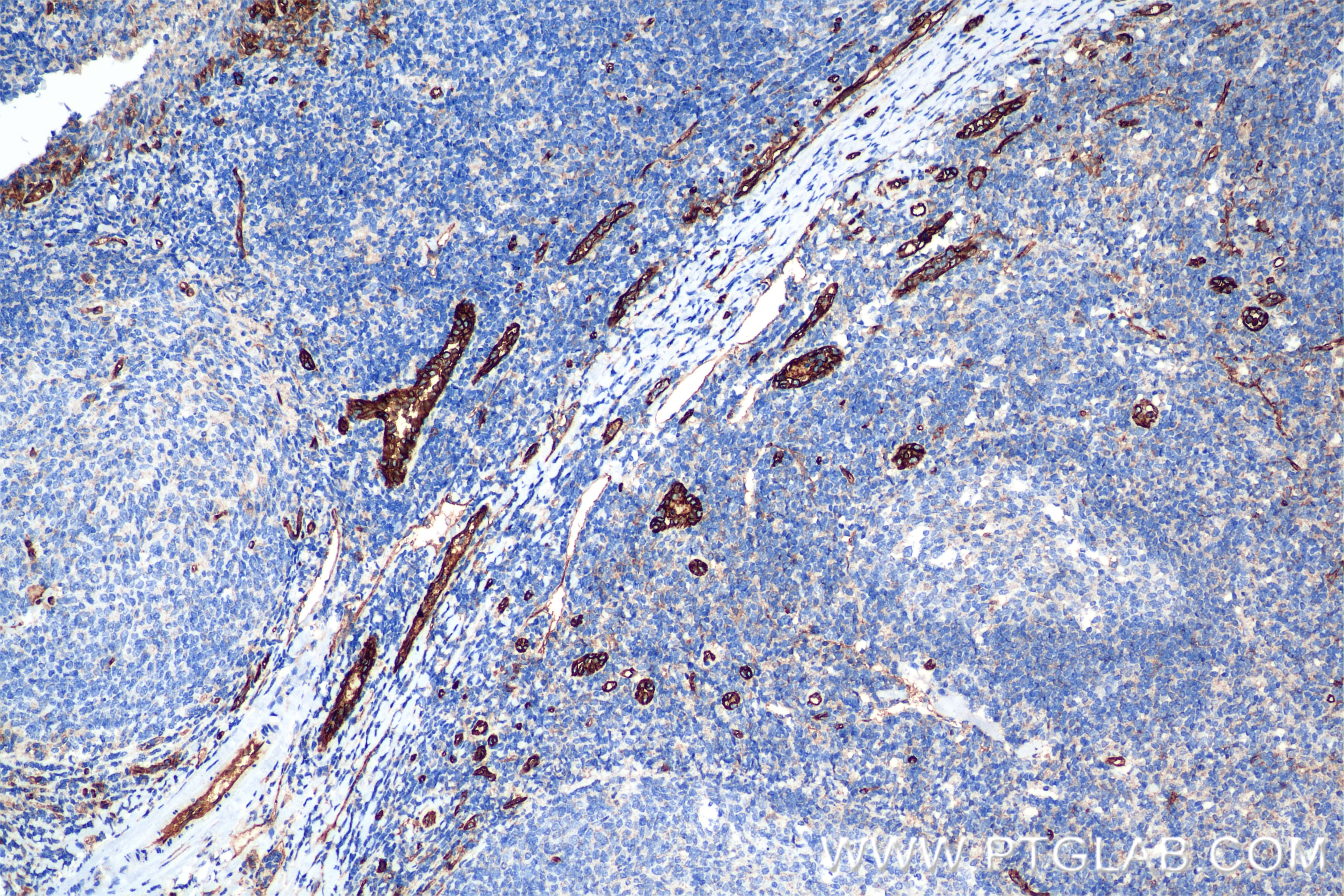 Immunohistochemistry (IHC) staining of human tonsillitis tissue using CD31 Recombinant antibody (80530-1-RR)