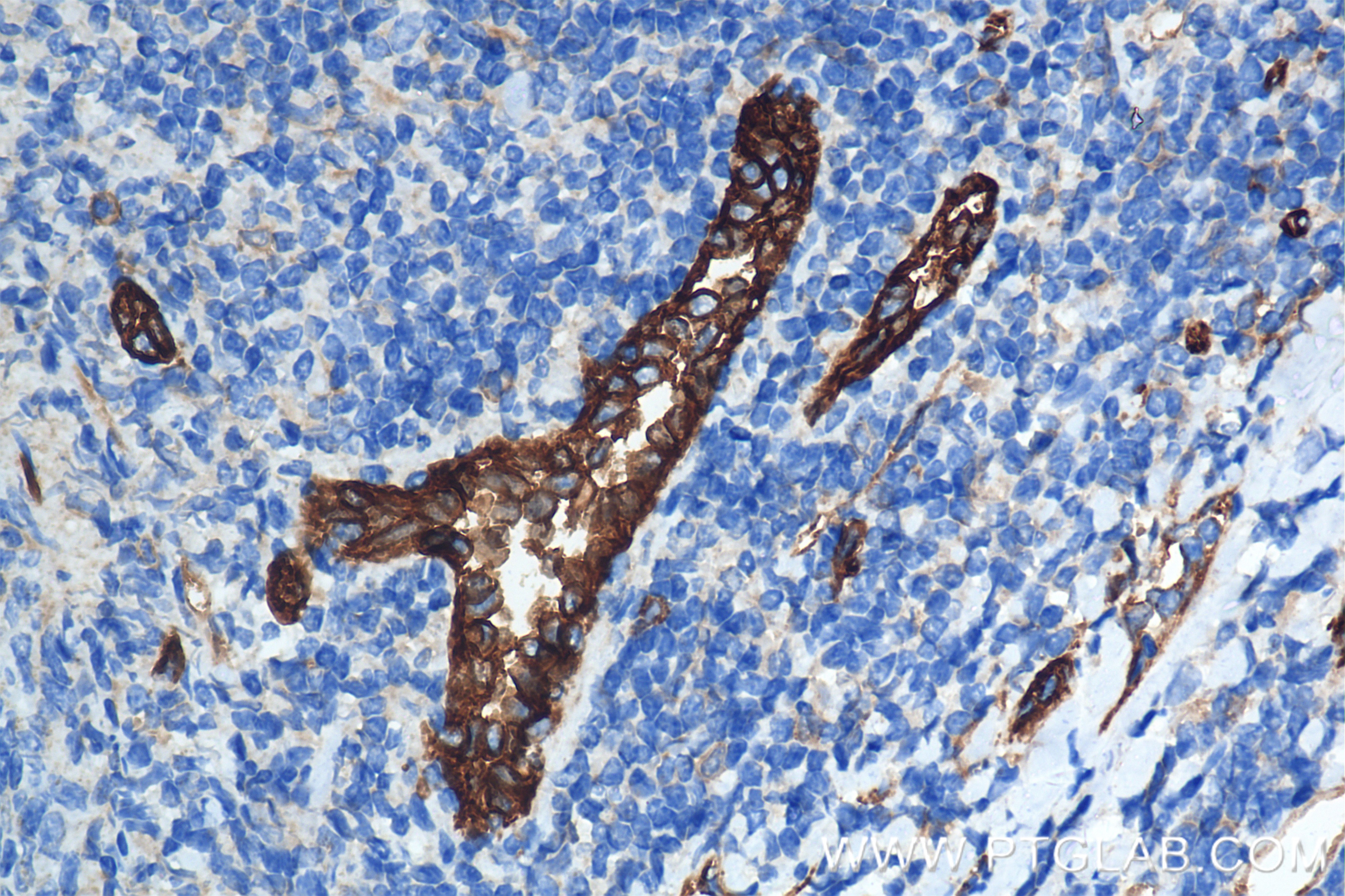 Immunohistochemistry (IHC) staining of human tonsillitis tissue using CD31 Recombinant antibody (80530-1-RR)