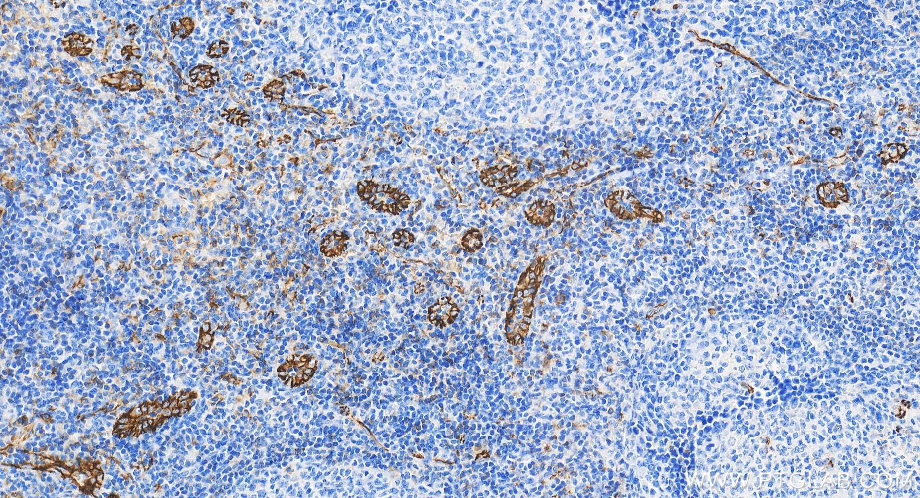Immunohistochemistry (IHC) staining of human tonsillitis tissue using CD31 Recombinant antibody (80773-4-RR)