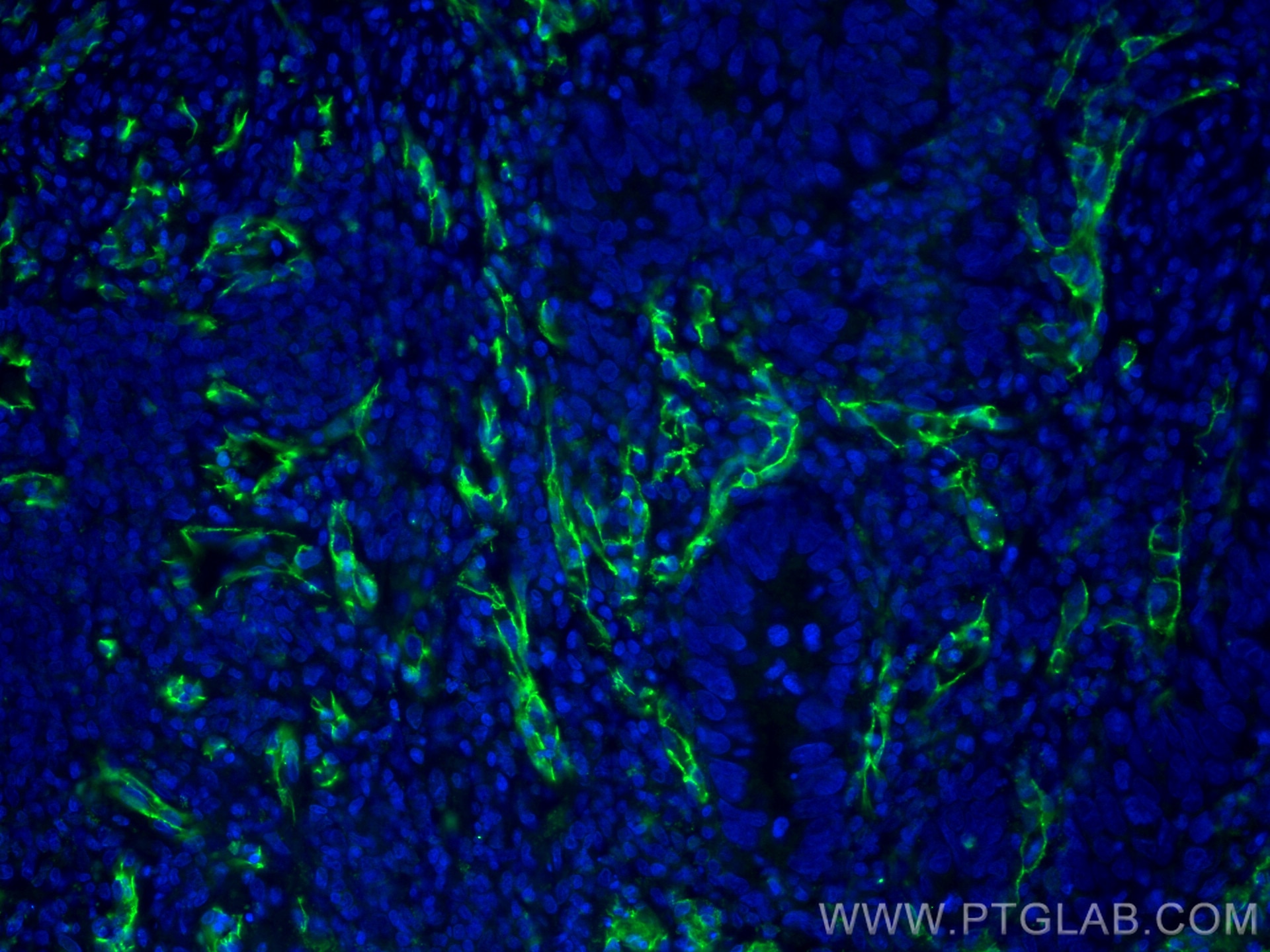 Immunofluorescence (IF) / fluorescent staining of human colon cancer tissue using CoraLite® Plus 488-conjugated CD31 Monoclonal anti (CL488-66065)