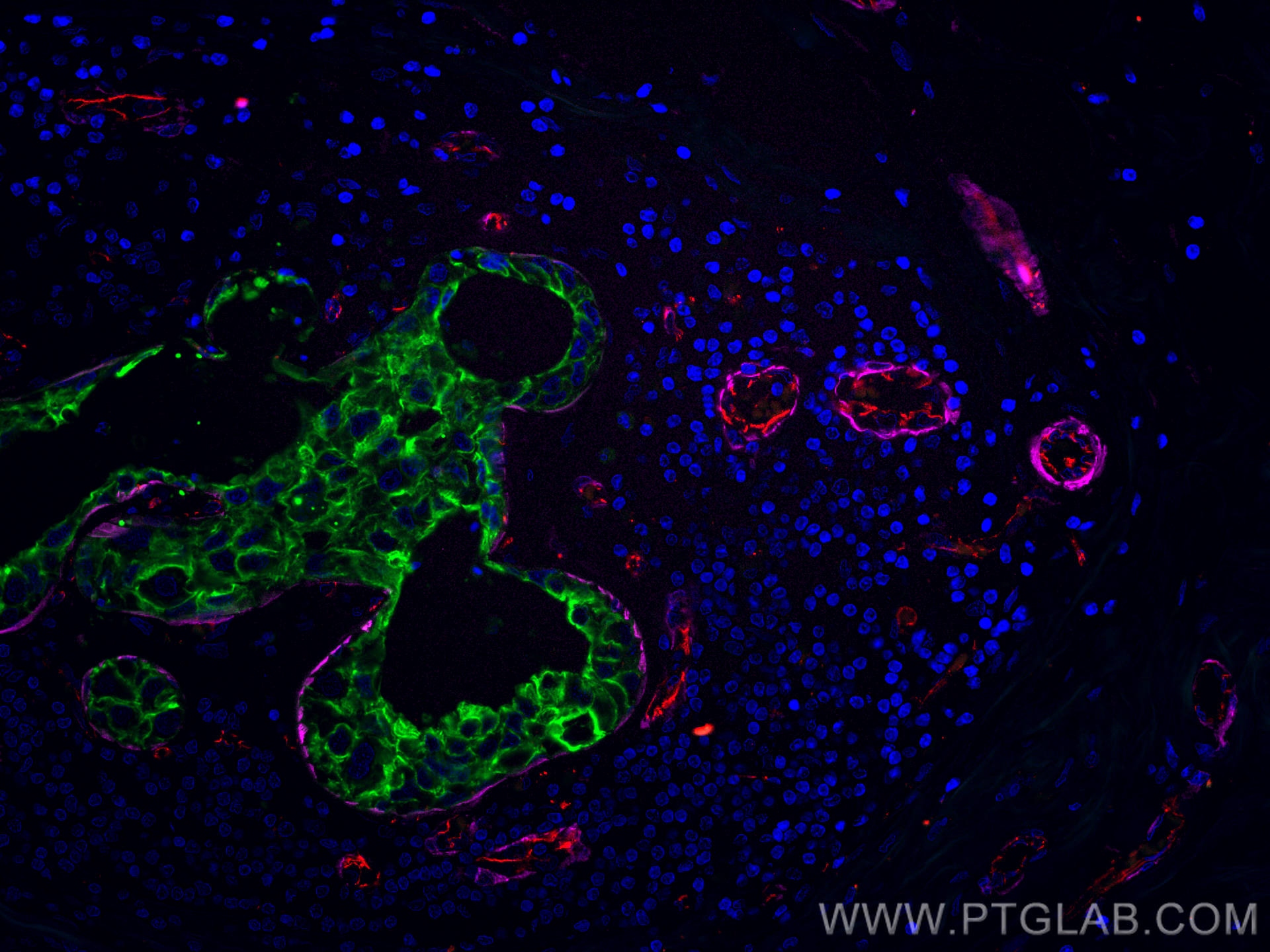 Immunofluorescence (IF) / fluorescent staining of human breast cancer tissue using CoraLite®594-conjugated CD31 Polyclonal antibody (CL594-11265)