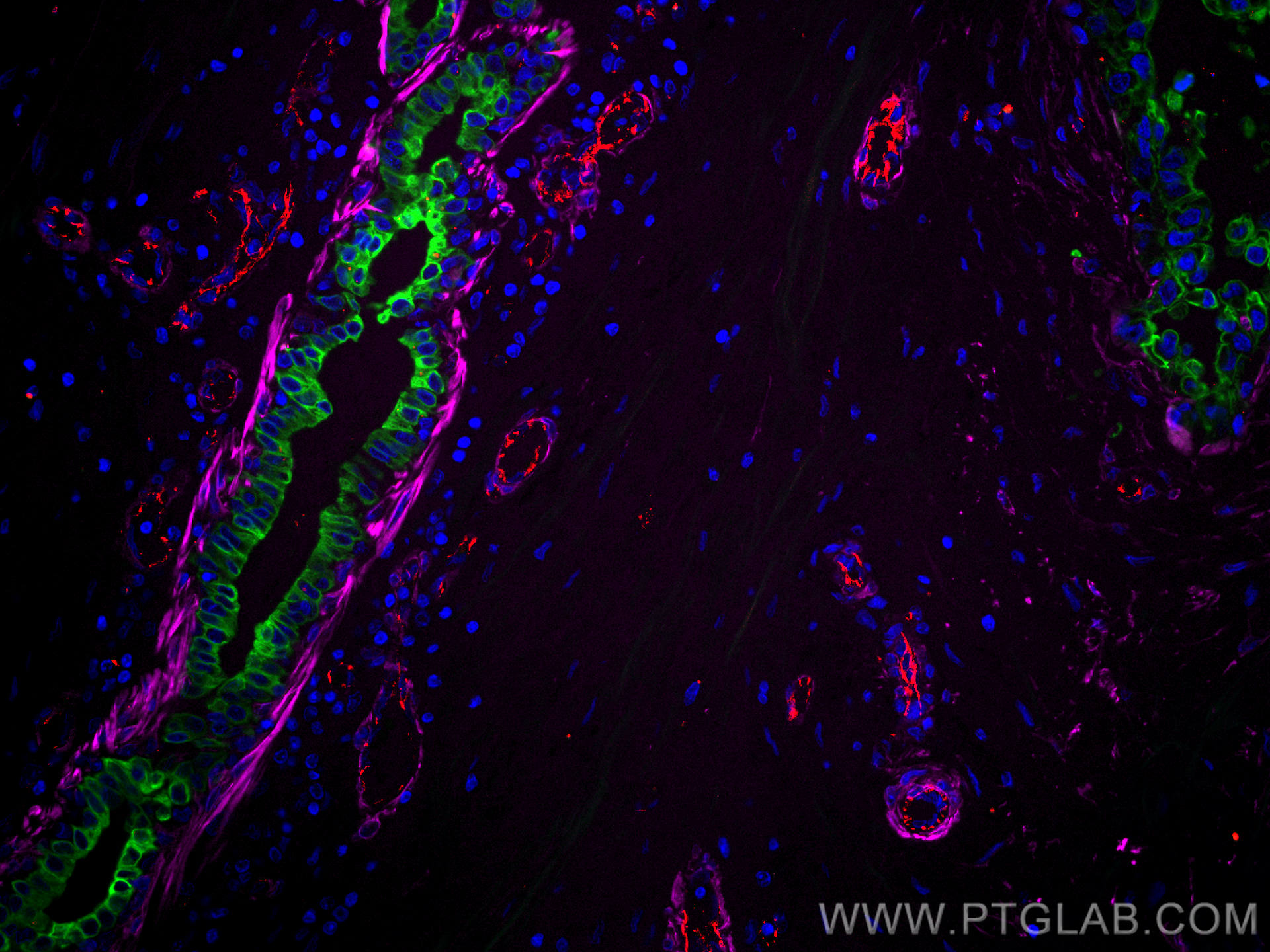 Immunofluorescence (IF) / fluorescent staining of human breast cancer tissue using CoraLite®594-conjugated CD31 Polyclonal antibody (CL594-11265)