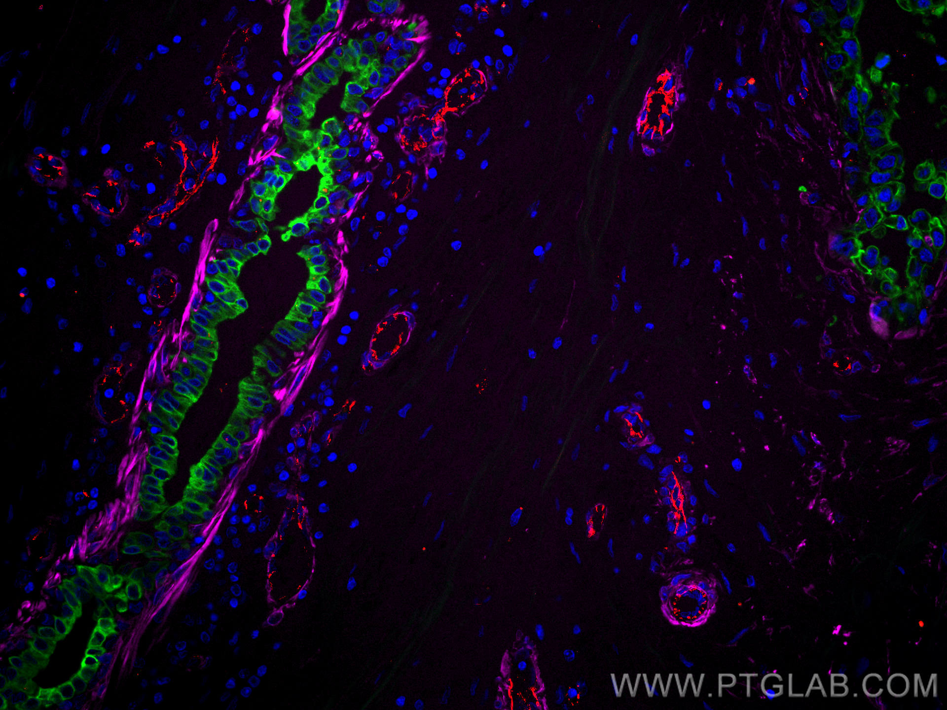 IF Staining of human breast cancer using CL594-11265