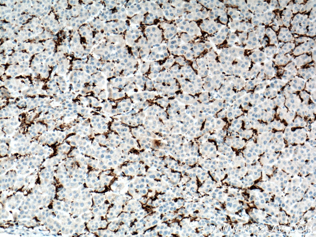 Immunohistochemistry (IHC) staining of human liver cancer tissue using FCGR2A / CD32a Monoclonal antibody (66529-1-Ig)
