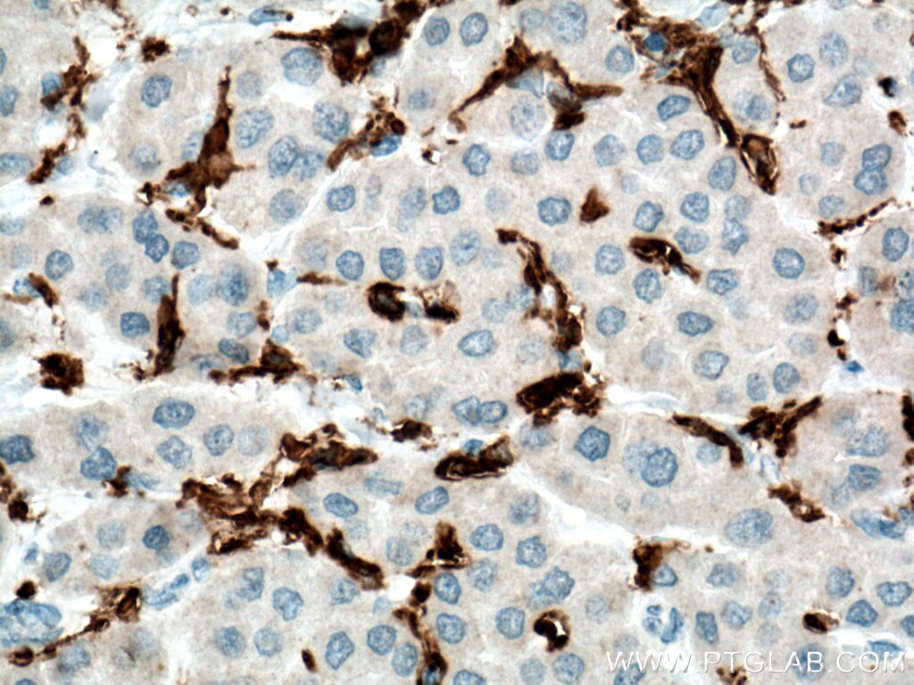 Immunohistochemistry (IHC) staining of human liver cancer tissue using FCGR2A / CD32a Monoclonal antibody (66529-1-Ig)