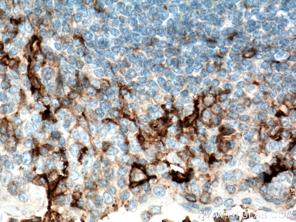 IHC staining of human tonsillitis using 66529-1-Ig