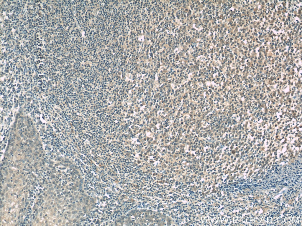 Immunohistochemistry (IHC) staining of human tonsillitis tissue using CD320 Polyclonal antibody (10343-1-AP)