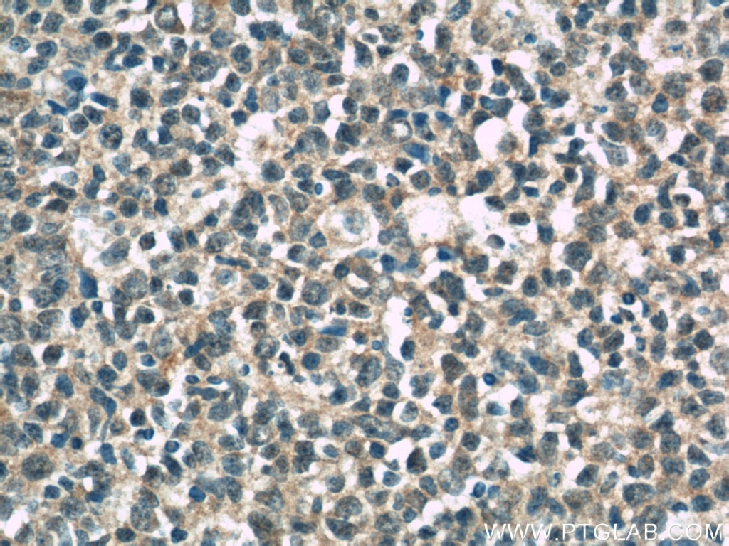 Immunohistochemistry (IHC) staining of human tonsillitis tissue using CD320 Polyclonal antibody (10343-1-AP)