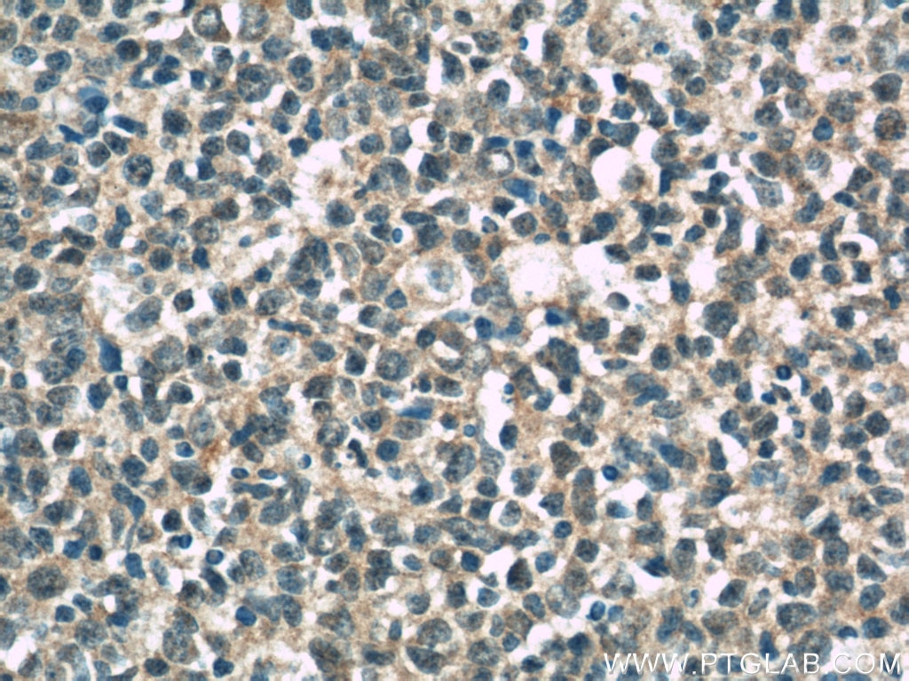 IHC staining of human tonsillitis using 10343-1-AP