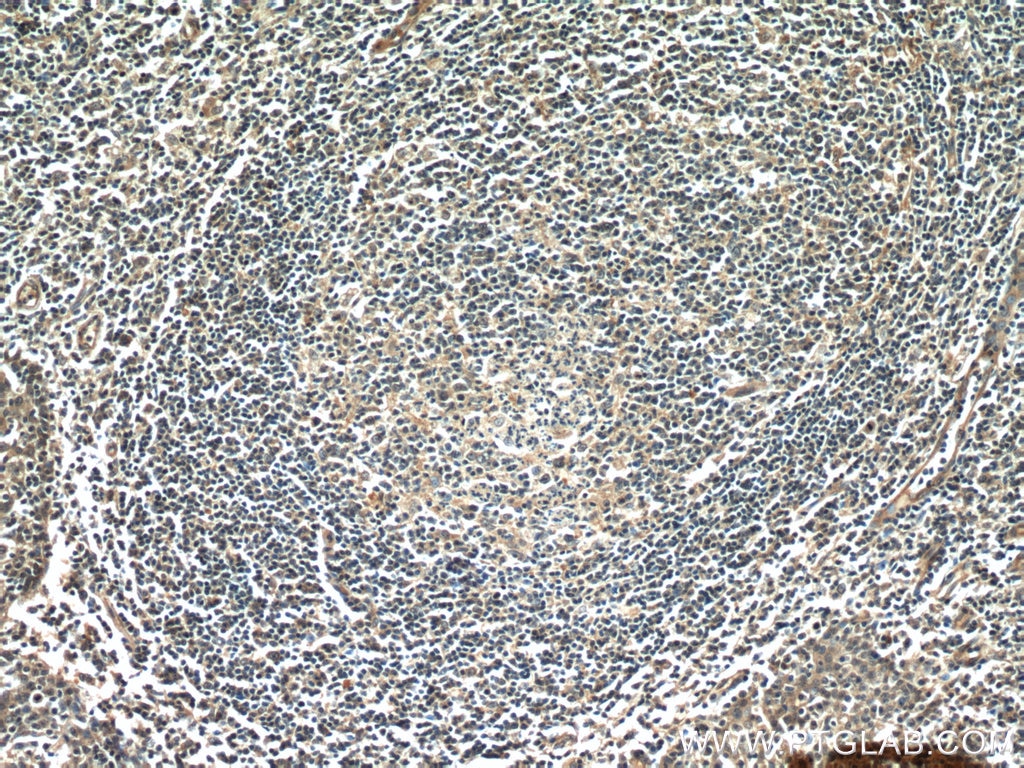 Immunohistochemistry (IHC) staining of human tonsillitis tissue using CD320 Polyclonal antibody (10343-1-AP)