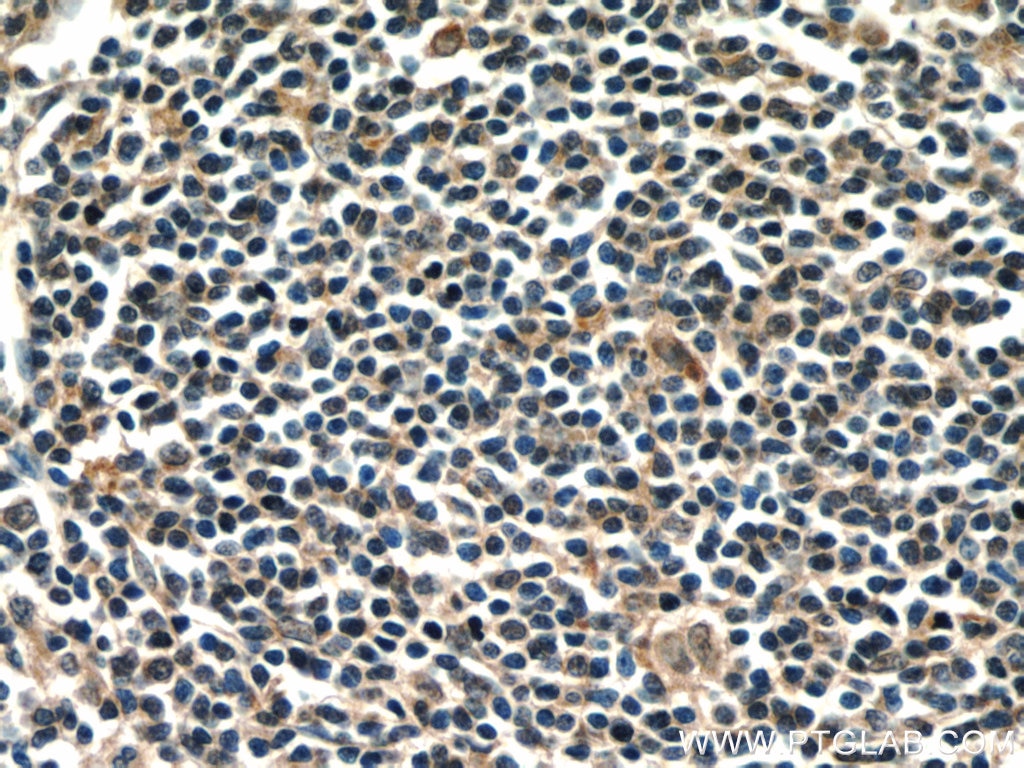 Immunohistochemistry (IHC) staining of human tonsillitis tissue using CD320 Polyclonal antibody (10343-1-AP)