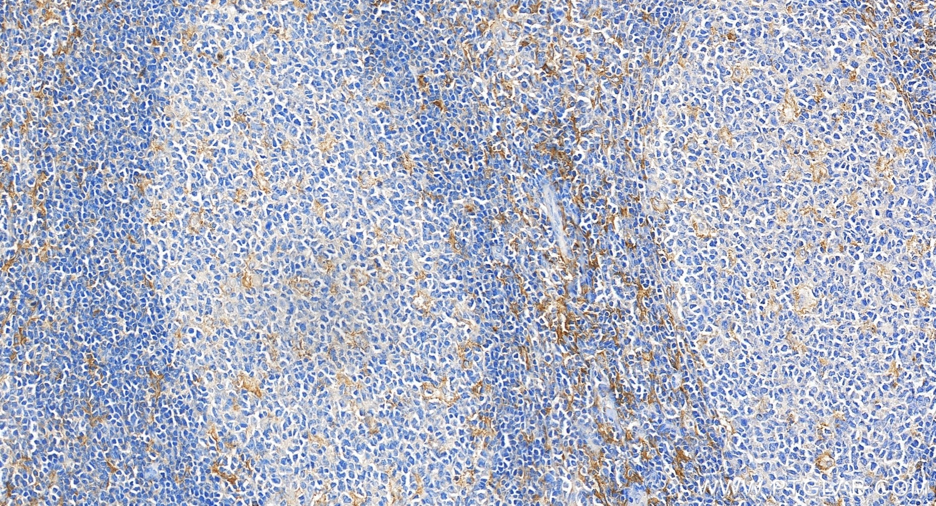 Immunohistochemistry (IHC) staining of human tonsillitis tissue using CD33 Recombinant monoclonal antibody (84341-6-RR)