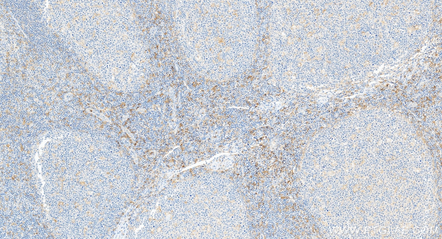 Immunohistochemistry (IHC) staining of human tonsillitis tissue using CD33 Recombinant monoclonal antibody (84341-6-RR)