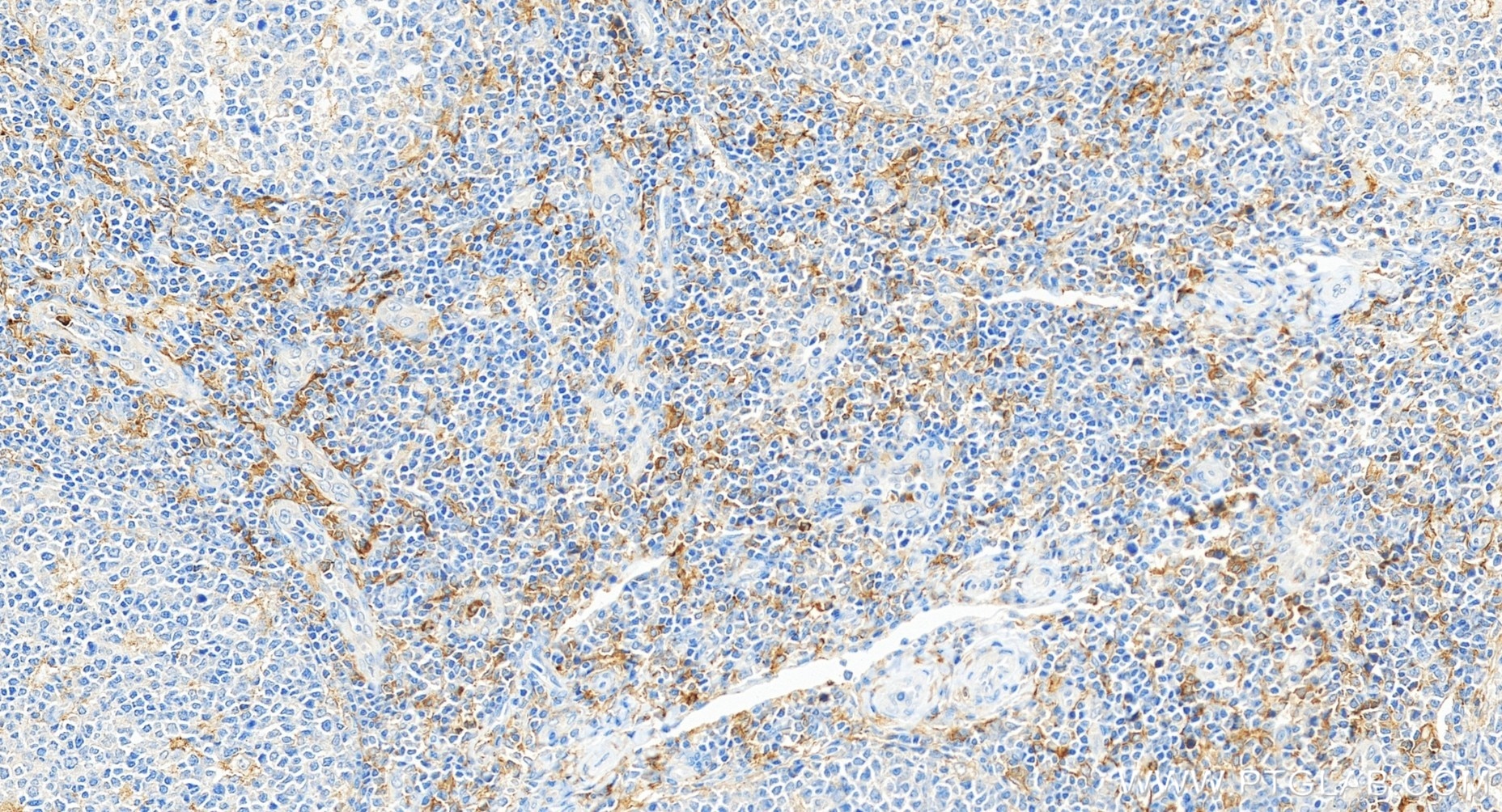 Immunohistochemistry (IHC) staining of human tonsillitis tissue using CD33 Recombinant monoclonal antibody (84341-6-RR)