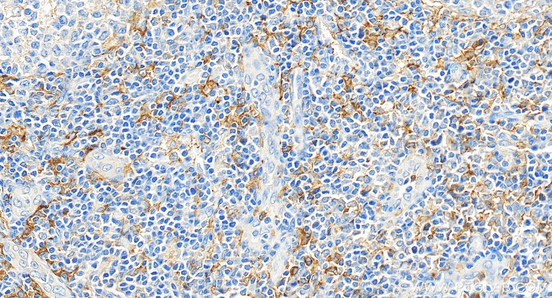 Immunohistochemistry (IHC) staining of human tonsillitis tissue using CD33 Recombinant monoclonal antibody (84341-6-RR)