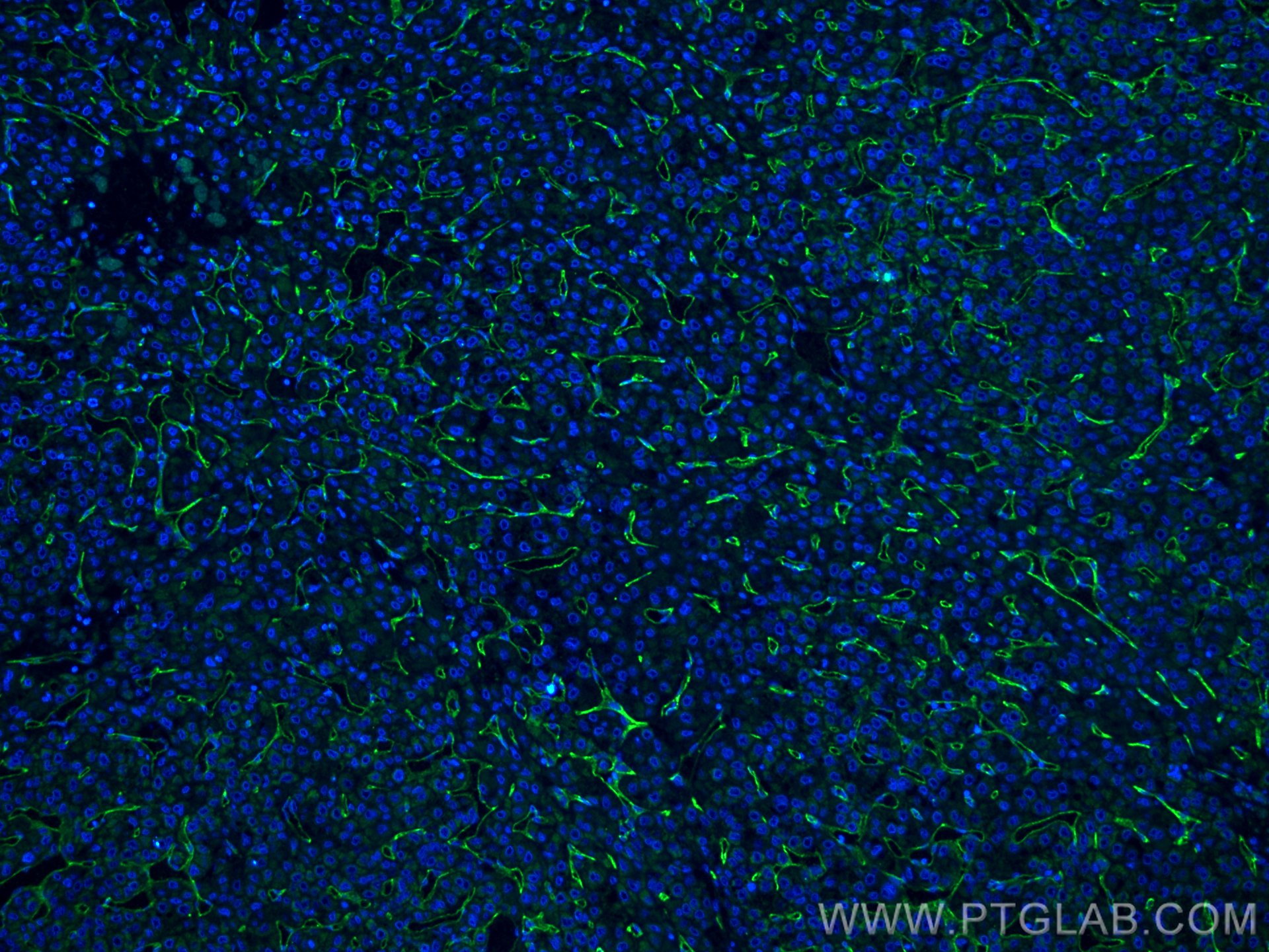 Immunofluorescence (IF) / fluorescent staining of human liver cancer tissue using CD34 Polyclonal antibody (14486-1-AP)