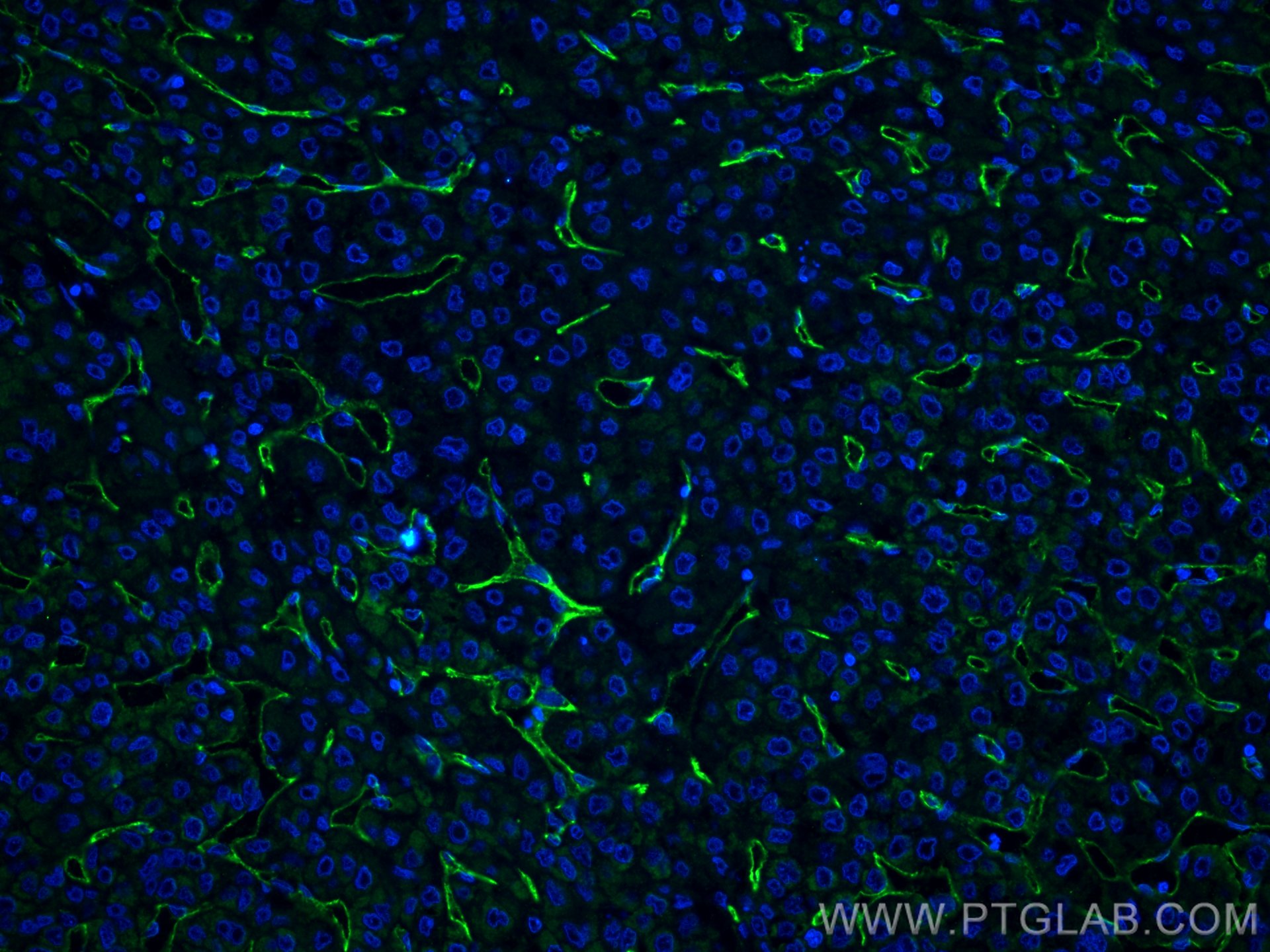 Immunofluorescence (IF) / fluorescent staining of human liver cancer tissue using CD34 Polyclonal antibody (14486-1-AP)